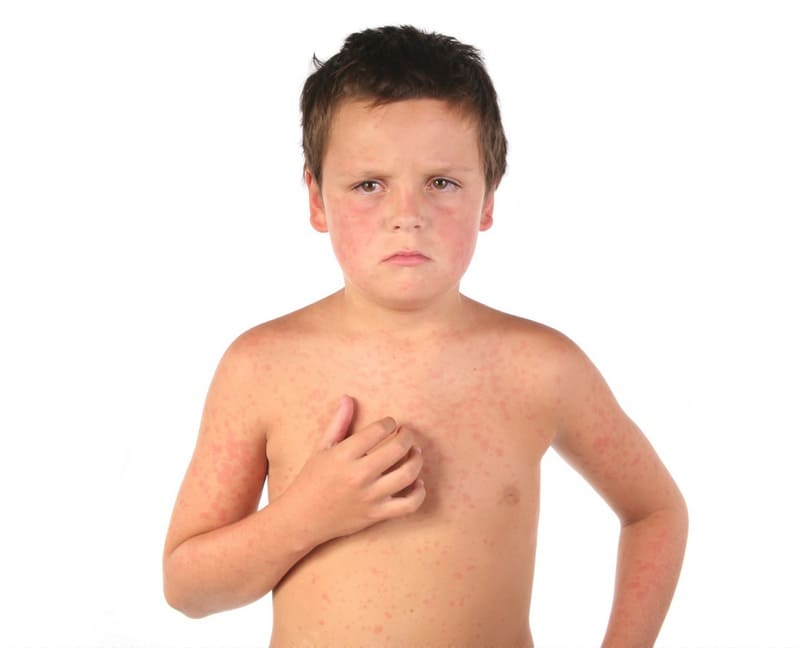 Атопический дерматит у детей: возможные осложнения